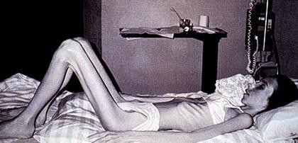 La anorexia puede ser un peligro mortal